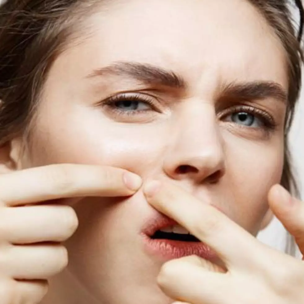 Nggak cuma pakai pasta gigi, ini cara bersihkan pori-pori tersumbat dengan tambahan 2 bahan dapur