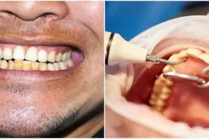 Tanpa campurkan baking soda, beauty vlogger ini bagikan cara hilangkan karang gigi pakai 1 bumbu dapur