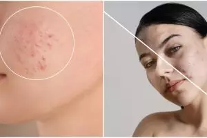 Tanpa acne cream, cara atasi jerawat membandel ini hanya pakai jus wortel dicampur 2 jenis rempah