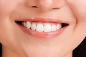 Bantu putihkan secara instan, ini arti, prosedur, biaya, dan efek samping bleaching gigi