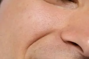 Nggak cuma putih telur, cewek ini bagikan trik merapatkan pori wajah dengan tambahan 1 bahan alami