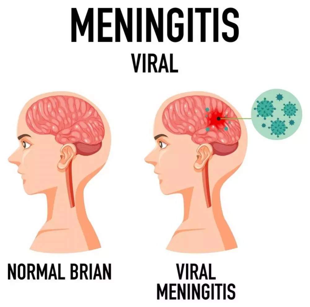 Meningitis, dampak, gejala, penyebab, dan cara pencegahannya © 2024 freepik.com