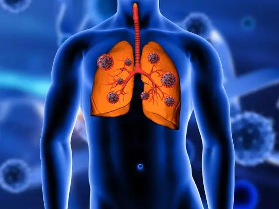 bahaya vaping untuk paru-paru © 2024 brilio.net