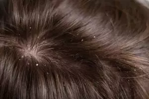 Nggak cuma lemon, TikToker ini unggah cara atasi ketombe membandel pakai tambahan 1 bahan dapur