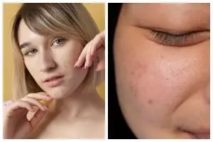Tanpa gunakan acne cream, cewek ini atasi jerawat dan bekasnya cuma manfaatkan 1 jenis rempah