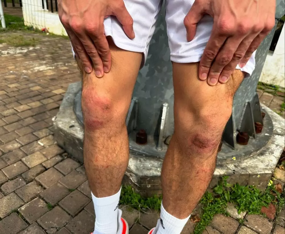 lutut thom haye lecet berbagai sumber lutut thom haye lecet berbagai sumber