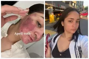 Perjuangan cewek sembuh dari jerawat parah selama 2 tahun, transformasinya jadi mulus bak beda orang