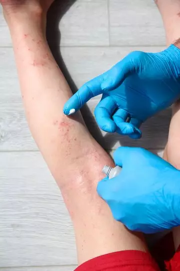 Waspada virus cacar monyet freepik.com  Waspada virus cacar monyet freepik.com