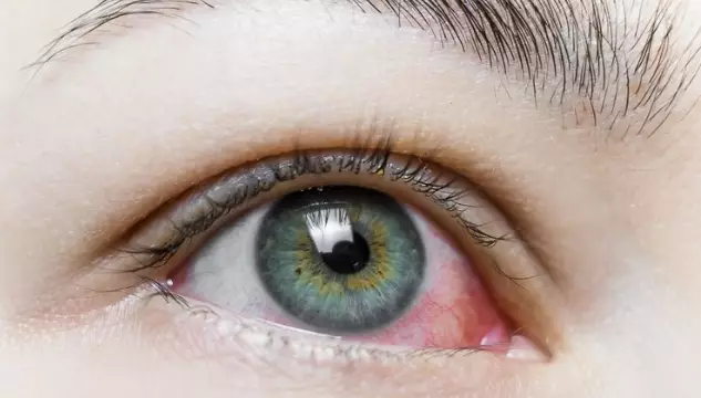 kesalahan memakai kontak lensa © 2024 brilio.net