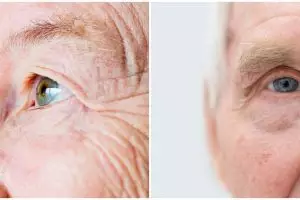 Mengenal glaukoma, kondisi gangguan saraf mata yang dialami Adul hingga alami kebutaan