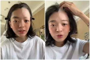 Kisah cewek alami vitiligo usai bleaching rambut ini bikin nyesek, bukti pentingnya patch test