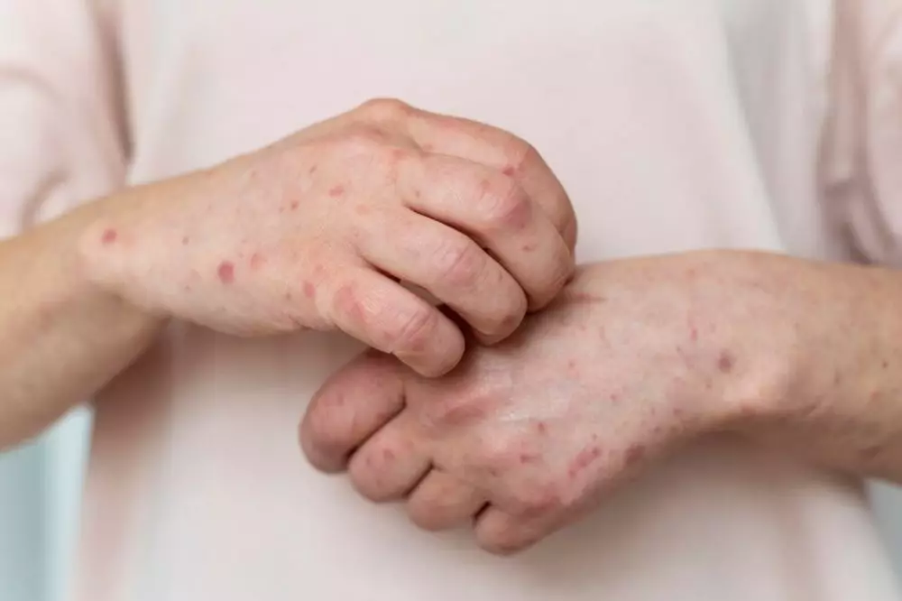 Makanan ini yang wajib dihindari penderita lupus © 2024 freepik.com Makanan ini yang wajib dihindari penderita lupus © 2024 freepik.com
