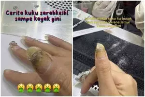 Kuku selebgram ini jadi busuk usai lakukan nail art, berubah menghitam akibat jamur