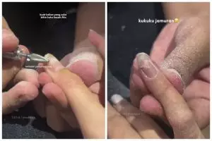 Niat bikin kuku jadi cantik malah jamuran, kisah cewek pakai nail tip ini bikin trauma seumur hidup