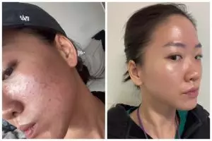 Wajah jadi breakout usai pakai sunscreen tak cocok, cewek ini bagikan kisahnya atasi kulit iritasi