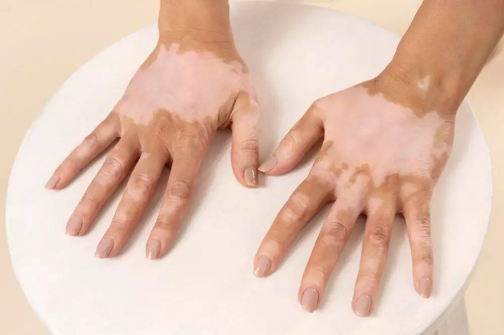 Cara mengobati vitiligo dengan bahan alami dan bantuan medis © 2024 freepik.com Cara mengobati vitiligo dengan bahan alami dan bantuan medis © 2024 freepik.com