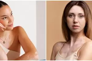 Cara mengobati penyakit kulit vitiligo dengan bahan alami dan bantuan medis