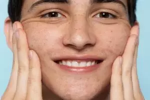 Buah ini bisa pudarkan flek hitam di wajah, begini cara membuat dan memakainya