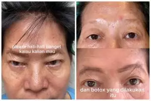 Niatnya hilangkan kerutan agar awet muda, emak-emak lakukan treatment botoks ini malah berakhir zonk