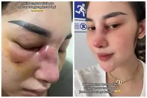 Kisah cewek gagal operasi hidung bukannya jadi lebih mancung, hasilnya justru bikin infeksi