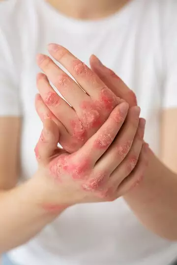 Mengenal penyakit kusta freepik.com Mengenal penyakit kusta freepik.com
