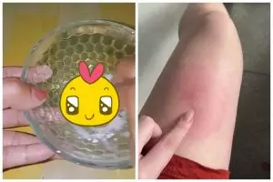 Tanpa dioles salep, ini cara redakan bekas gigitan serangga di kulit cuma tambah 1 bumbu dapur