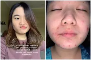 Wajah mulus cewek ini malah jerawatan parah usai pakai serum, akibat iseng gonta-ganti produk