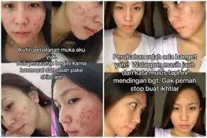Alami breakout hingga merah karena faktor hormonal, cewek ini beri cara sembuhkan jerawat di wajahnya