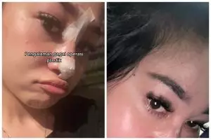 Kisah cewek gagal operasi hidung ini hasil awalnya bagus, endingnya infeksi sampai keluar nanah