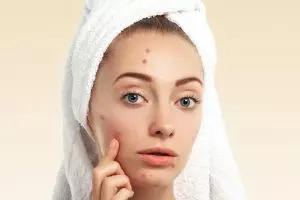 [KUIS] Acne fighters merapat! Cara kamu menangani jerawat sesuai jenisnya sudah tepat belum sih?