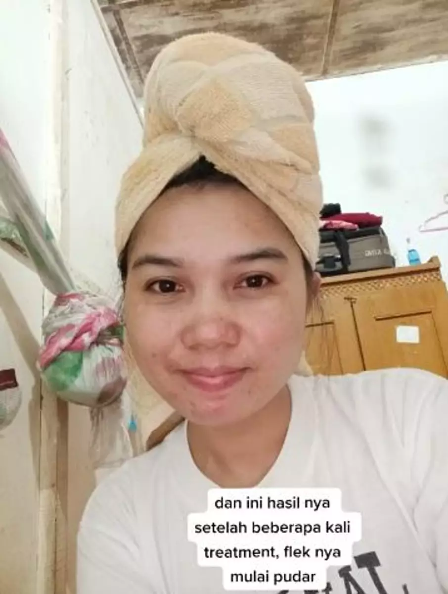 Wajah cewek penuh flek hitam akibat gonta-ganti skincare TikTok Wajah cewek penuh flek hitam akibat gonta-ganti skincare TikTok