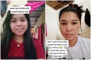 Wajah cewek ini jadi penuh flek hitam akibat gonta-ganti skincare, potret before-afternya bikin nyesek