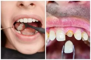 Auto putih dan tak bau mulut, ini cara rontokkan karang gigi cuma pakai obat kumur dari 1 jenis rempah