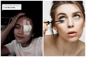 Akibat tak hapus maskara saat tidur, cerita wanita harus operasi mata karena bintitan ini bikin ngilu