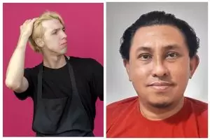 Kisah pria alami bengkak di kepala usai pakai cat rambut tak cocok, 11 transformasinya bikin miris