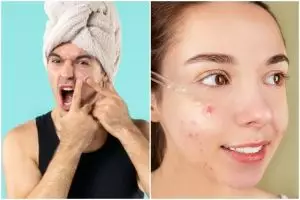 [KUIS] Salah produk bikin makin parah, yuk cari tahu bahan aktif untuk atasi jerawat sesuai jenisnya