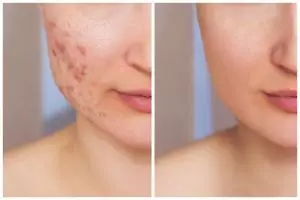 9 Rekomendasi skincare The Originote untuk kulit berjerawat, ampuh kontrol minyak di wajah