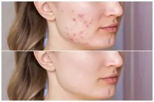 11 Rekomendasi skincare menghilangkan beruntusan di bawah Rp 150 ribu ini bikin wajah mulus kembali