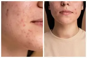 9 Rekomendasi skincare yang mengandung salicylic acid ini bantu hempaskan jerawat