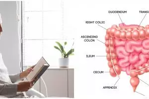 Cenderung ditemukan pada anak muda, 9 Kebiasaan yang tanpa disadari memicu kanker usus