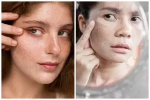 [KUIS] Cari tahu jenis flek hitam yang ada di wajahmu lewat pertanyaan singkat ini