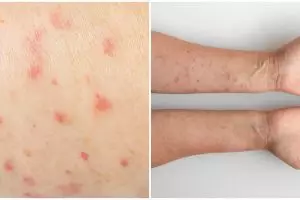 Waspada cacar api, kenali tanda-tanda awal dan langkah pengobatannya