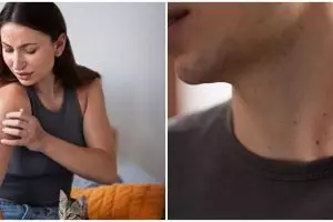 7 Bahaya penyakit kebiasaan bertukar pakaian, bisa tularkan infeksi jamur menular