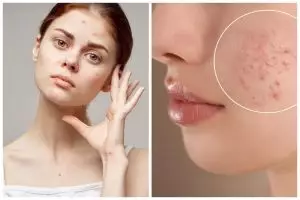 9 Cara mengatasi wajah bruntusan akibat skincare ini cuma andalkan bahan alami