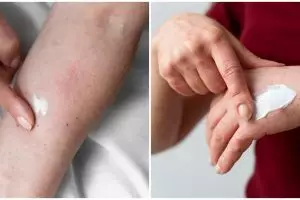 Hati-hati bertukar pakaian ke orang lain, kenali penyakit kurap, gejala, penyebab, dan cara mengatasi