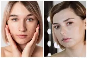 9 Serum skincare Somethinc untuk atasi jerawat ini bikin wajah auto halus dan bebas kemerahan