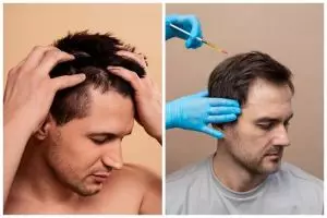 [KUIS] Before-after seleb usai transplantasi rambut pilihanmu ini ungkap gaya rambut yang sesuai