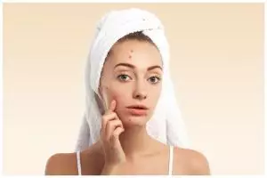 [KUIS] Hati-hati jerawatan, cari tahu kebiasaan yang tak boleh dilakukan saat skincare-an di sini!