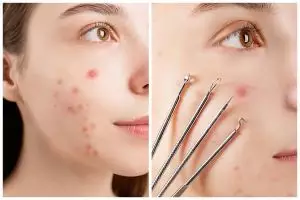 [KUIS] Kamu biasa hilangkan jerawat dengan apa? Cek seberapa efektif cara kamu dalam mengatasinya