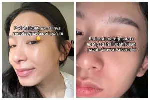 Asal coba pakai masker viral, wajah wanita yang awalnya mulus malah jadi breakout
